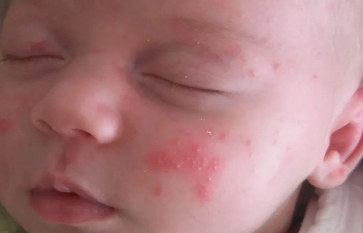 신생아 뾰루지 원인