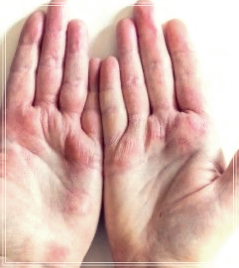 손등에 수포가 생긴다면? 원인과 효과적인 관리 방법 알아보기