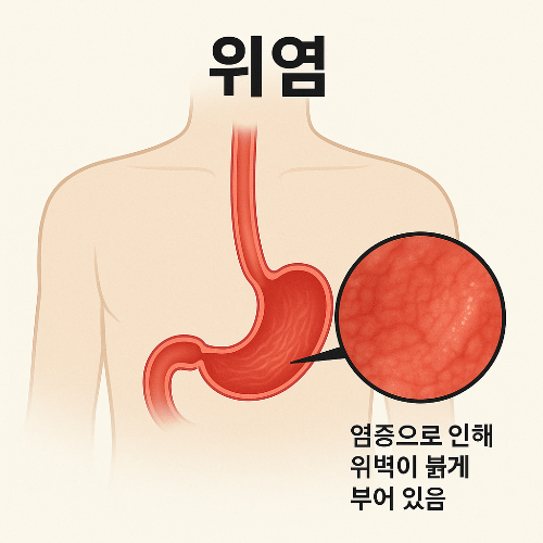 신경성 위염 증상 원인 치료