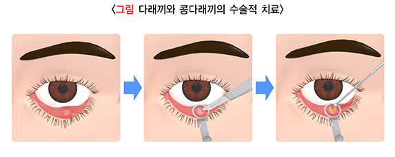 다래끼와 콩다래끼의 수술적 치료 관련 이미지