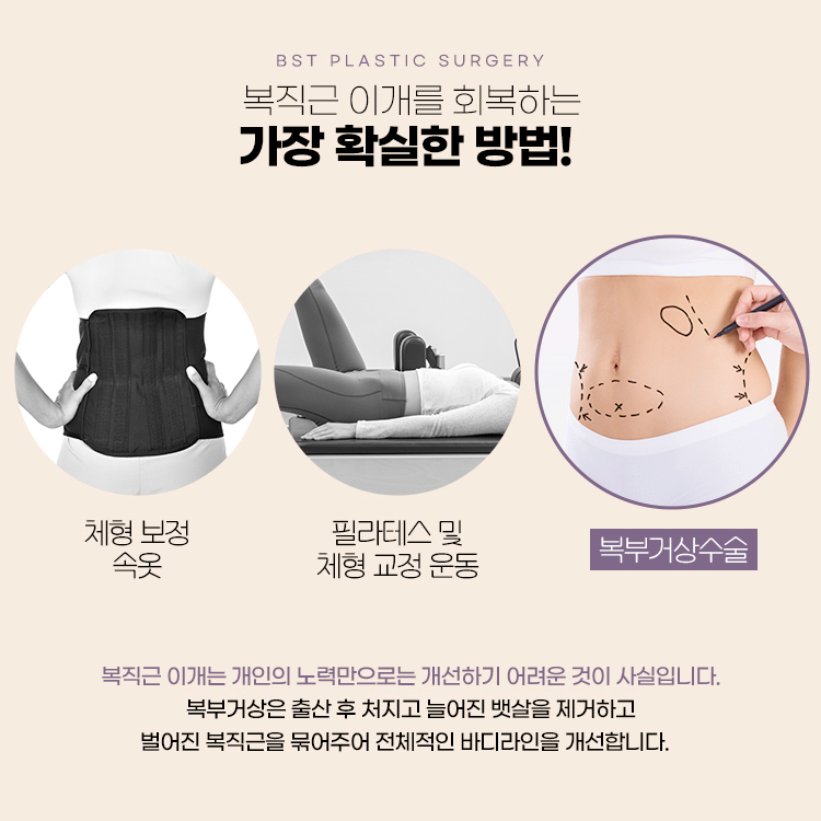복직근이개는 개인의 노력만으로는 개선하기 어려운 것이 사실입니다.
복주거상은 출산 후 처지고 늘어진 뱃살을 제거하고
벌어진 복직근을 묶어주며 전체적인 바디라인을 개선합니다.