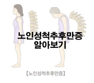 노인성 척추후만증