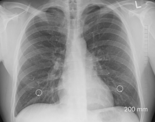 MBP 효능 부작용6