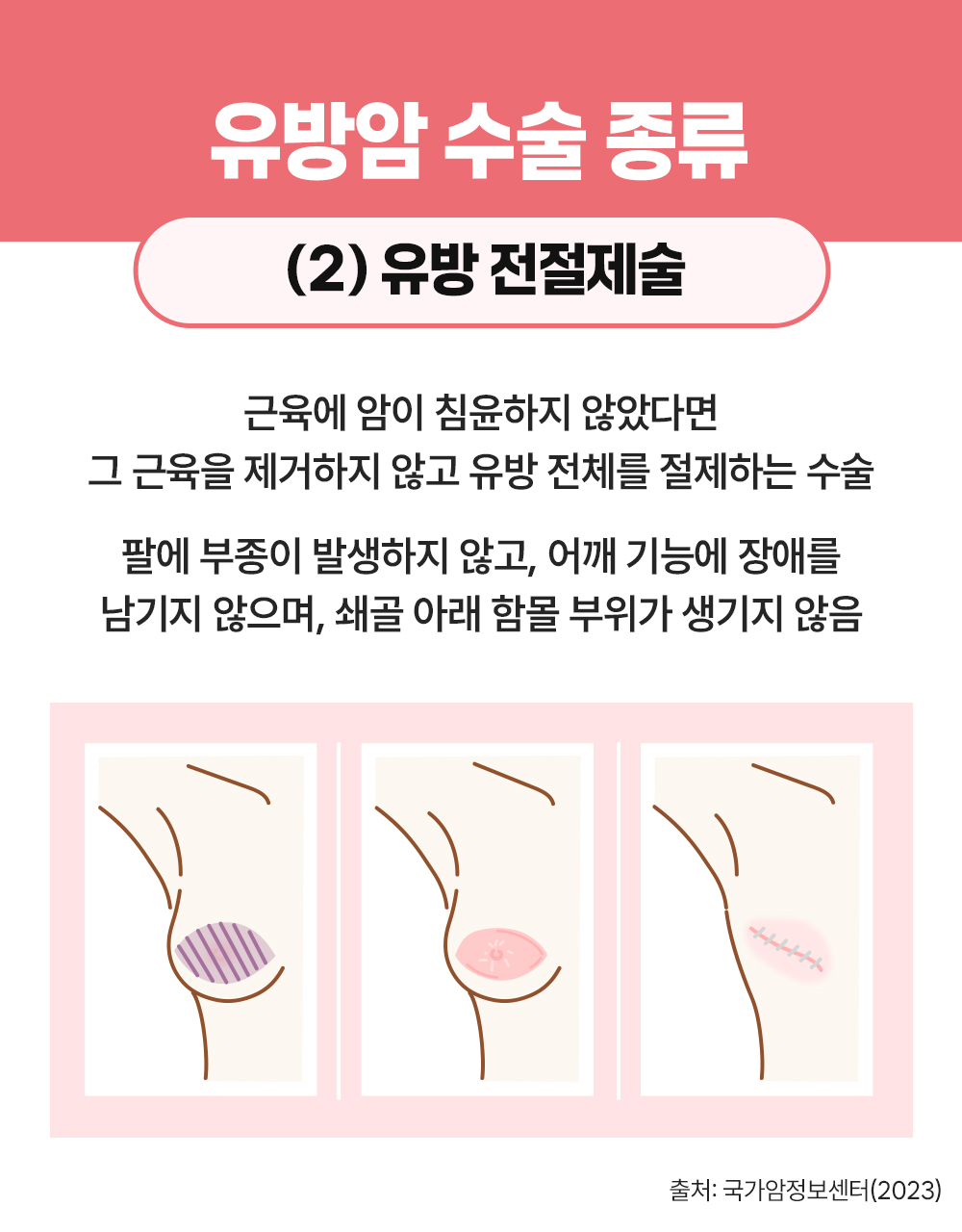 #유방암 수술 종류 유방 전절제술