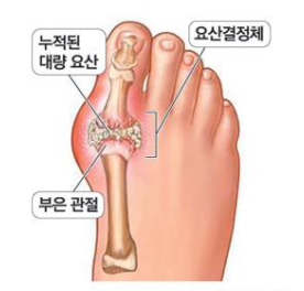 통풍증상-엄지발가락-부은 관절-누적된 대량 요산-요산결정체