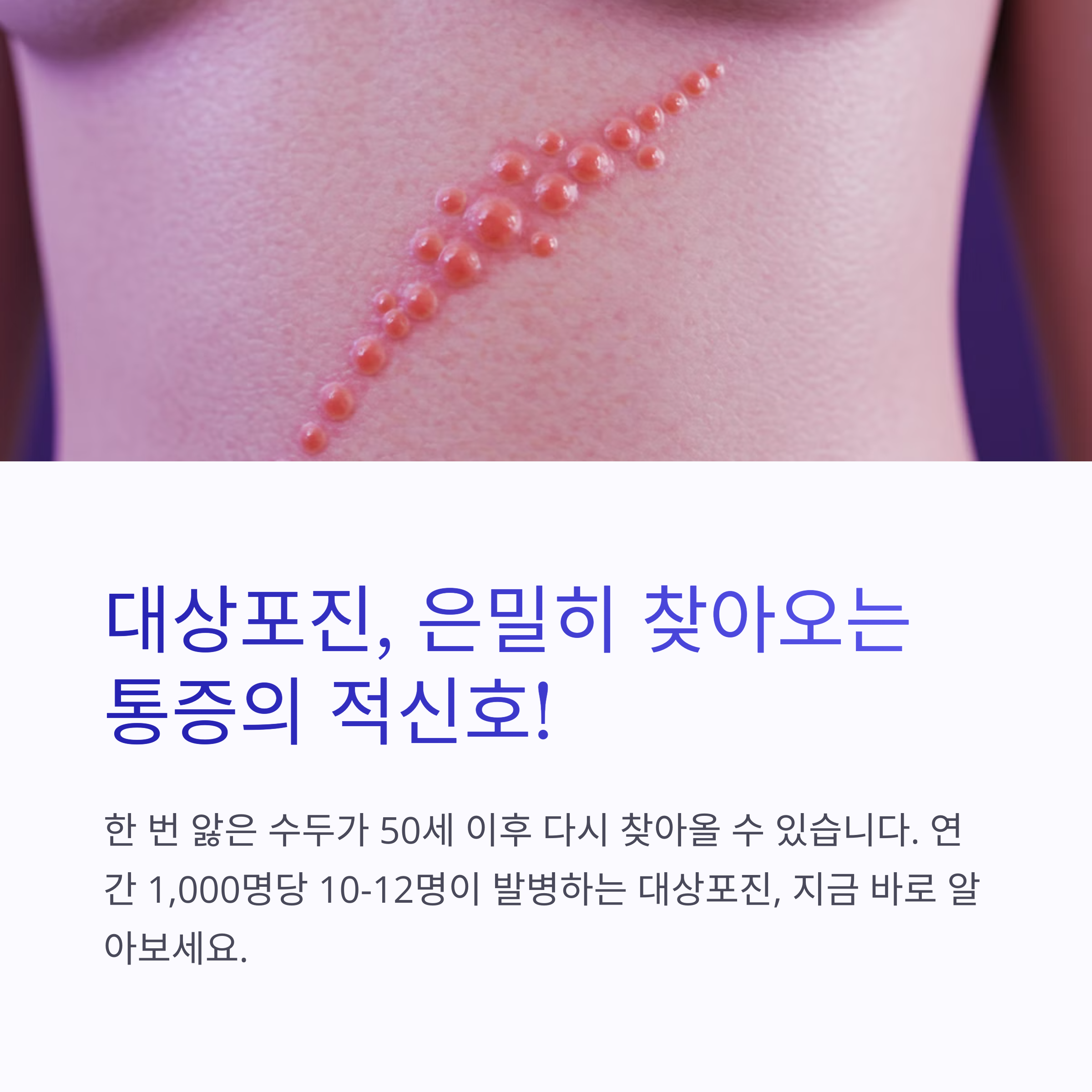대상포진알아두면좋은것