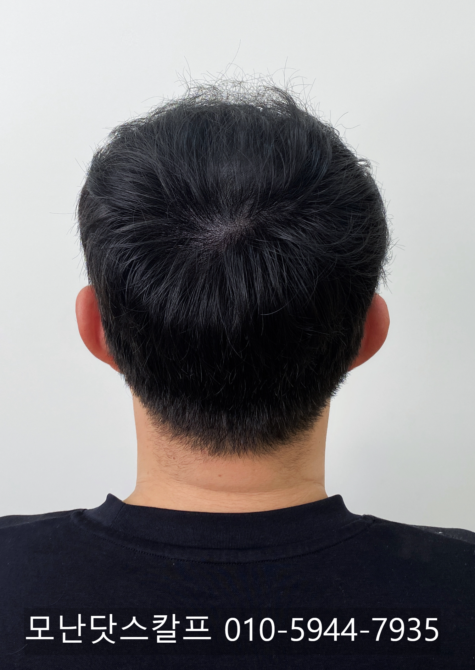 의정부 탈모문신 정수리 커버 후