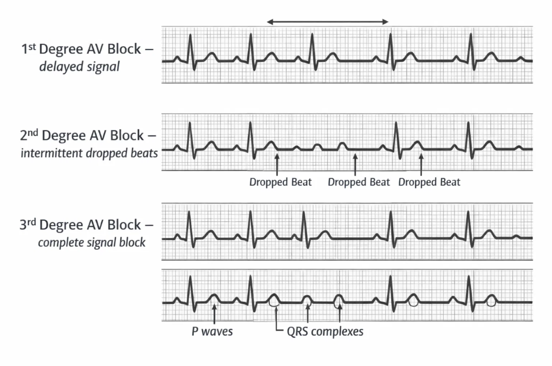방실차단 1도 2도 3도의 차이를 보여주는 심전도 파형 비교 이미지