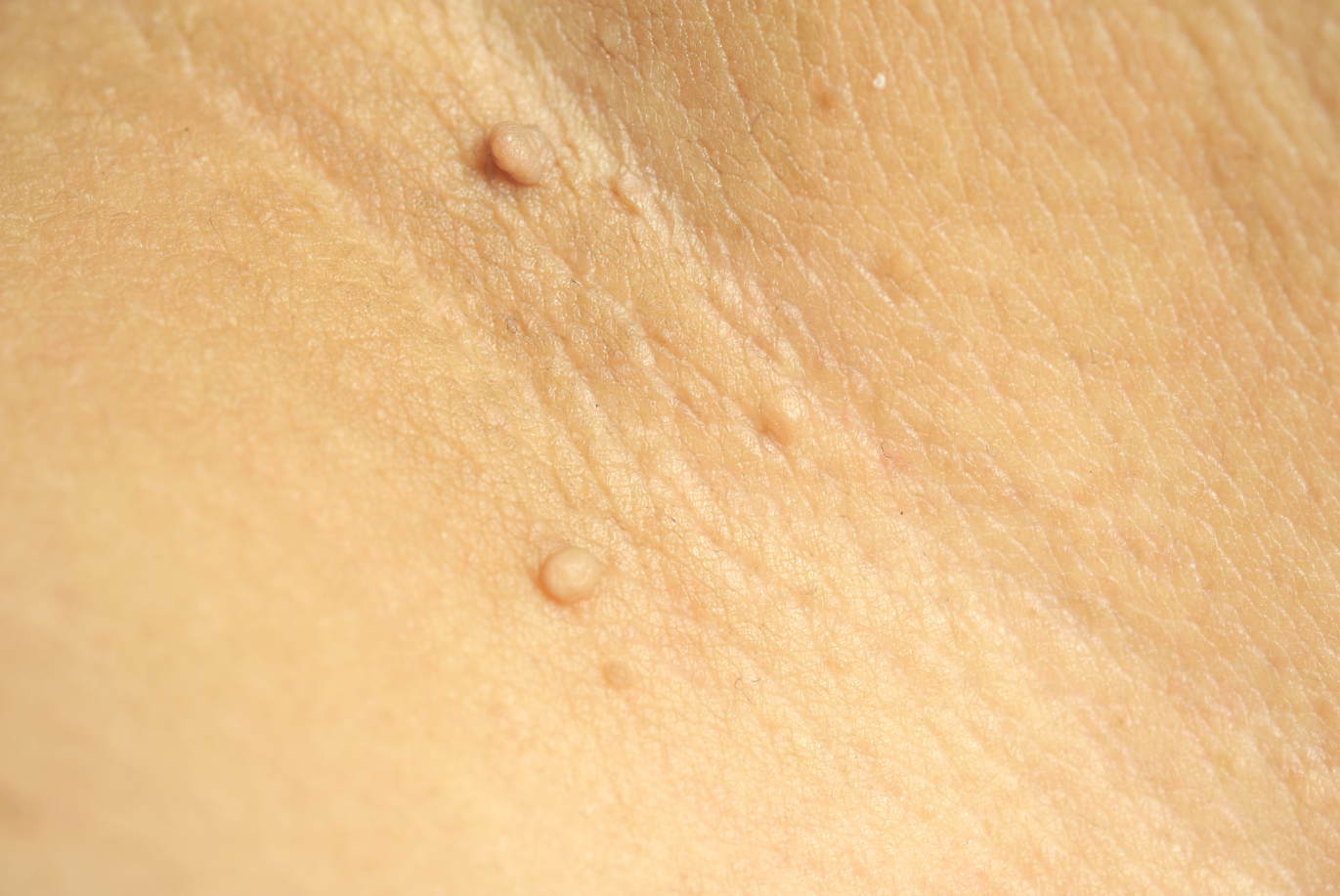 쥐젖은 연성 섬유종이라고 불린다