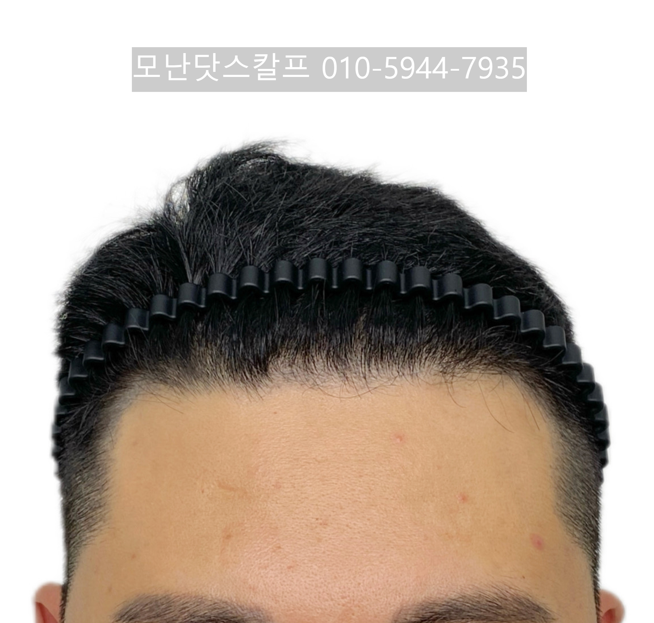 의정부 남자 헤어라인 두피문신 전