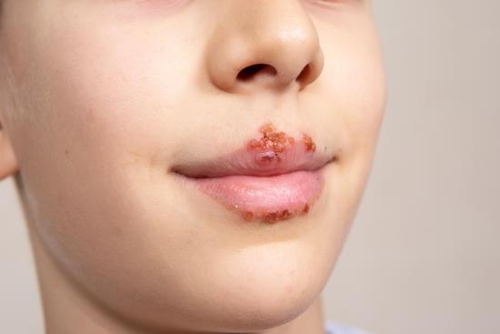 단순포진 (Herpes Simplex): 원인, 증상, 치료 및 예방