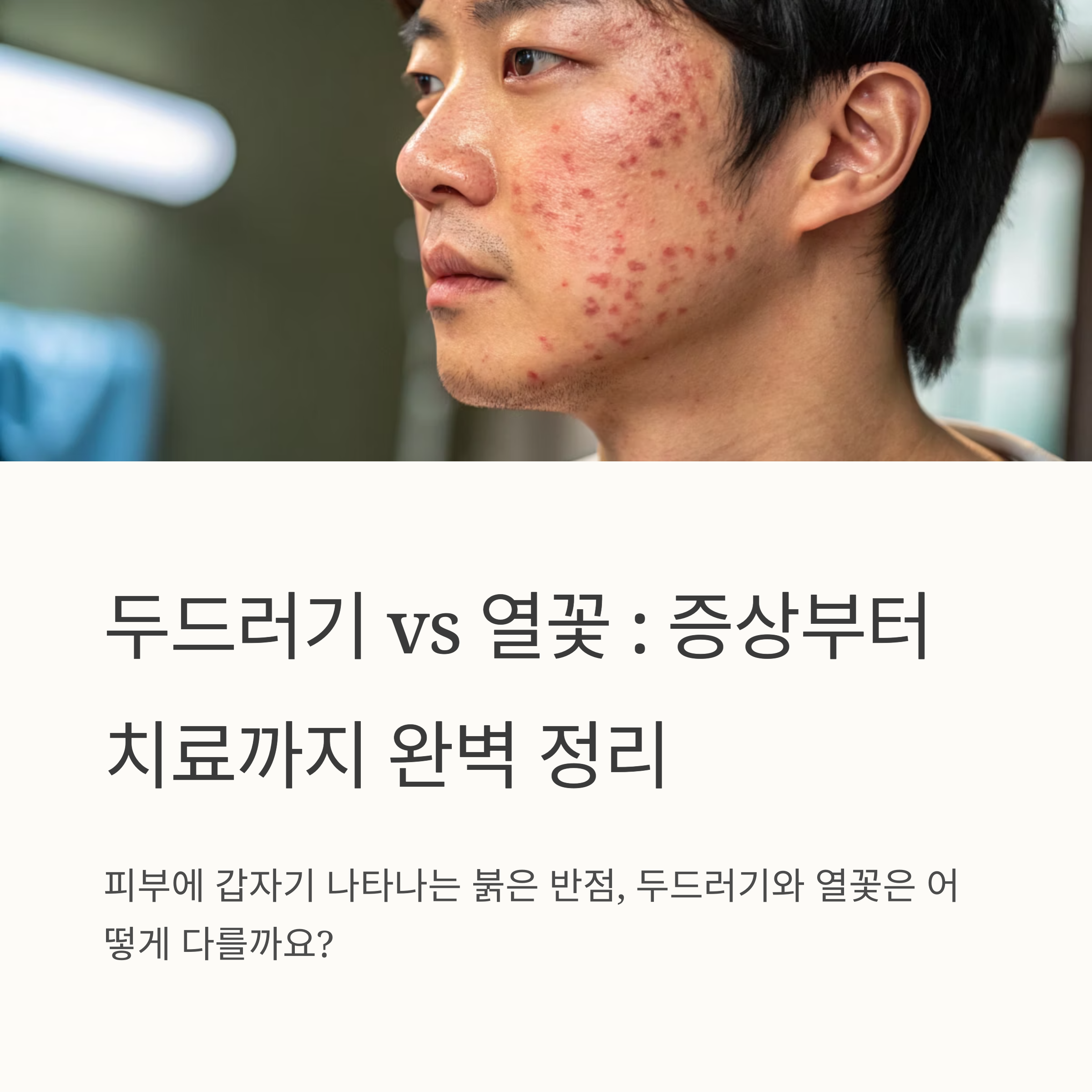 두드러기 vs 열꽃
