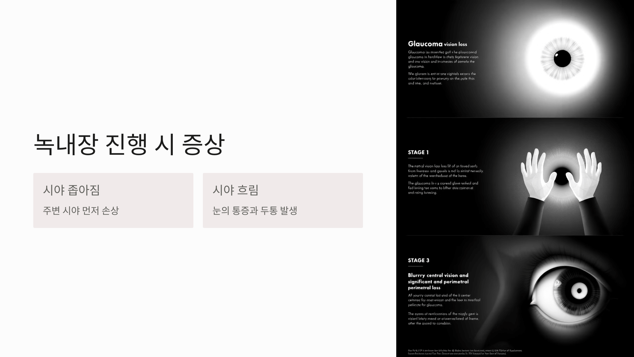 녹내장과 관련된 사진입니다.