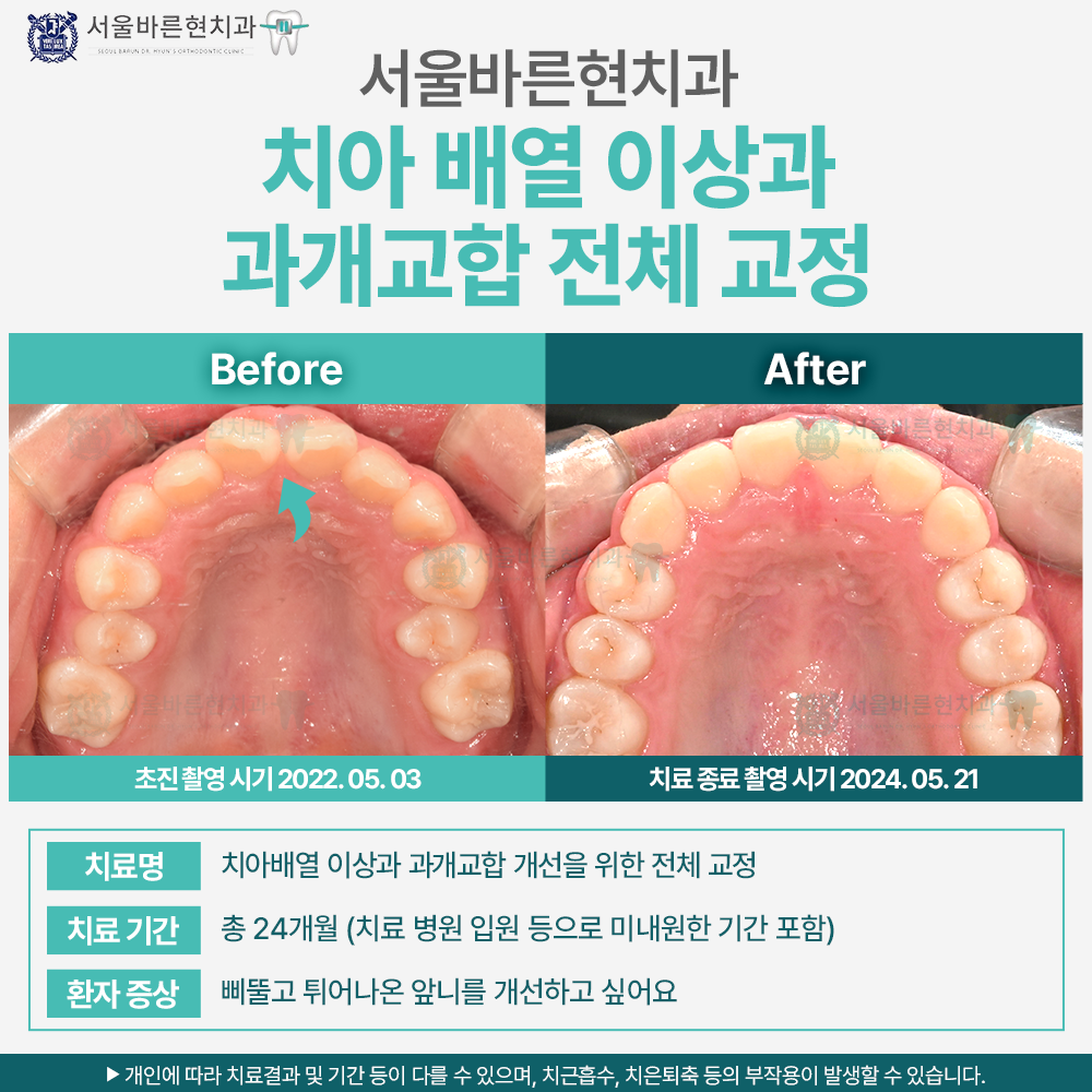 부산치아교정