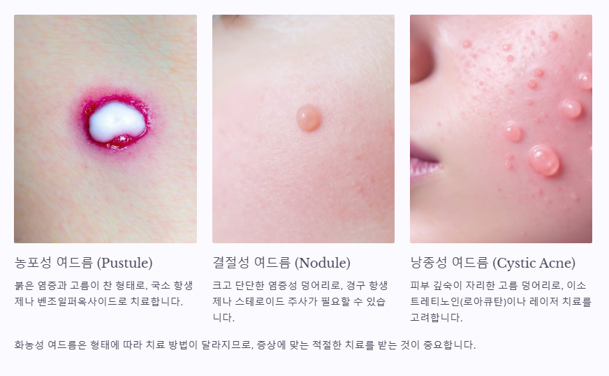 화농성 여드름의 종류