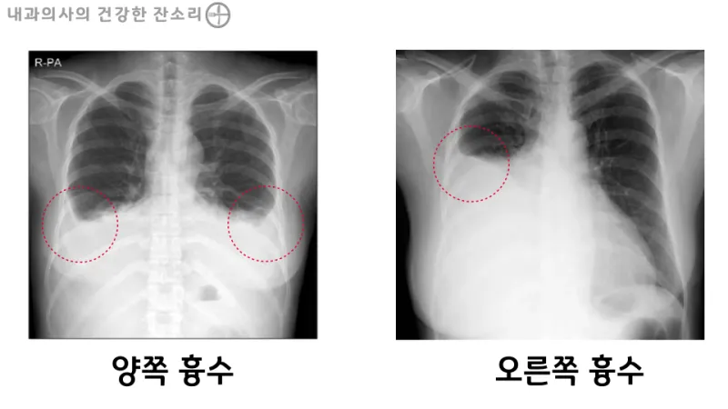 폐에 물이 차는 원인 증상 물참 관리 포인트에 대한 건강정보_5