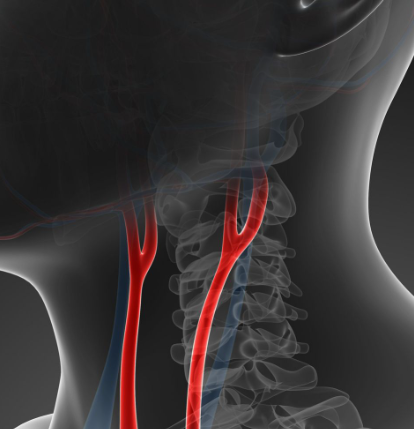 경동맥 초음파 검사란? mra 플라크 수치