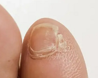 발톱갈라짐1