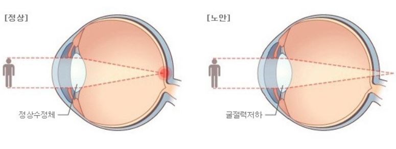 노안증상