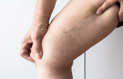 하지 정맥류 초기증상과 베나실 발거술 등의 치료방법 장단점