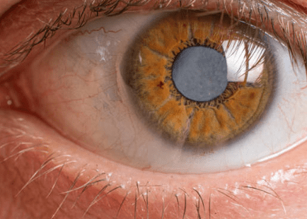 백내장 수술비용