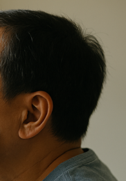 녹내장 초기증상