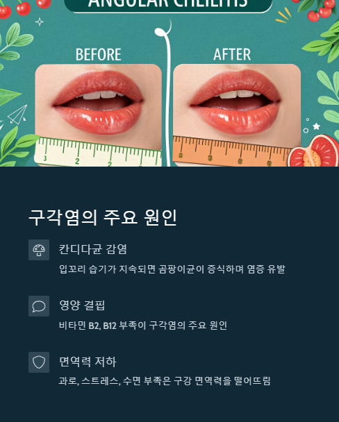 구각염의 주요 원인