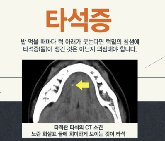 타석증이란, 타석증 증상 수술 치료, 수술입원기간 알아보기(최신)