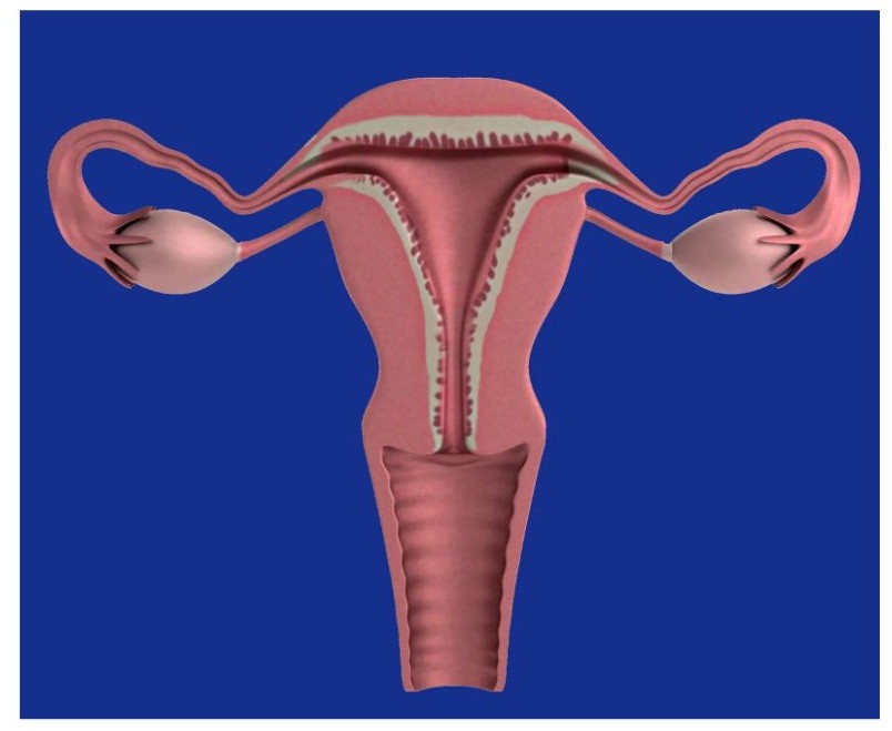 자궁내막증 증상