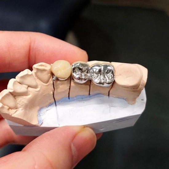 임플란트 시술과정 단계별 설명15