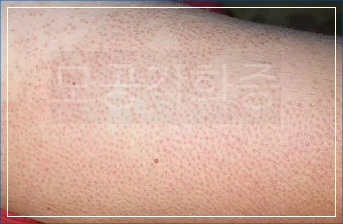 다리 모공각화증