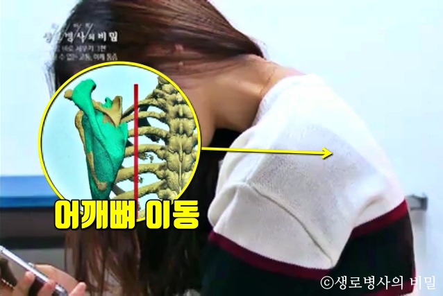 어깨통증 원인, 어깨충돌증후군 증상 원인, 어깨 운동,건강 팁줌마 매일꿀정보