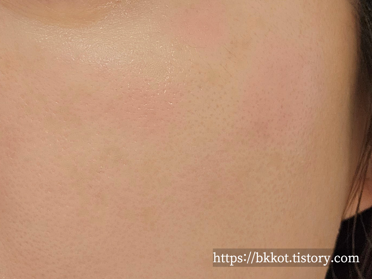 리팟레이저 후기