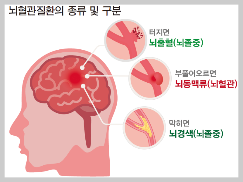 뇌졸증