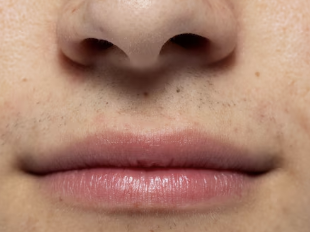 간경화 초기증상 28