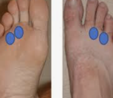 발바닥 통증부위