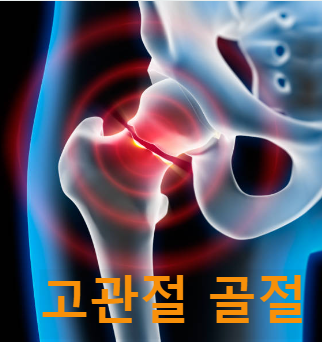 고관절 골절, 고관절 통증 증상