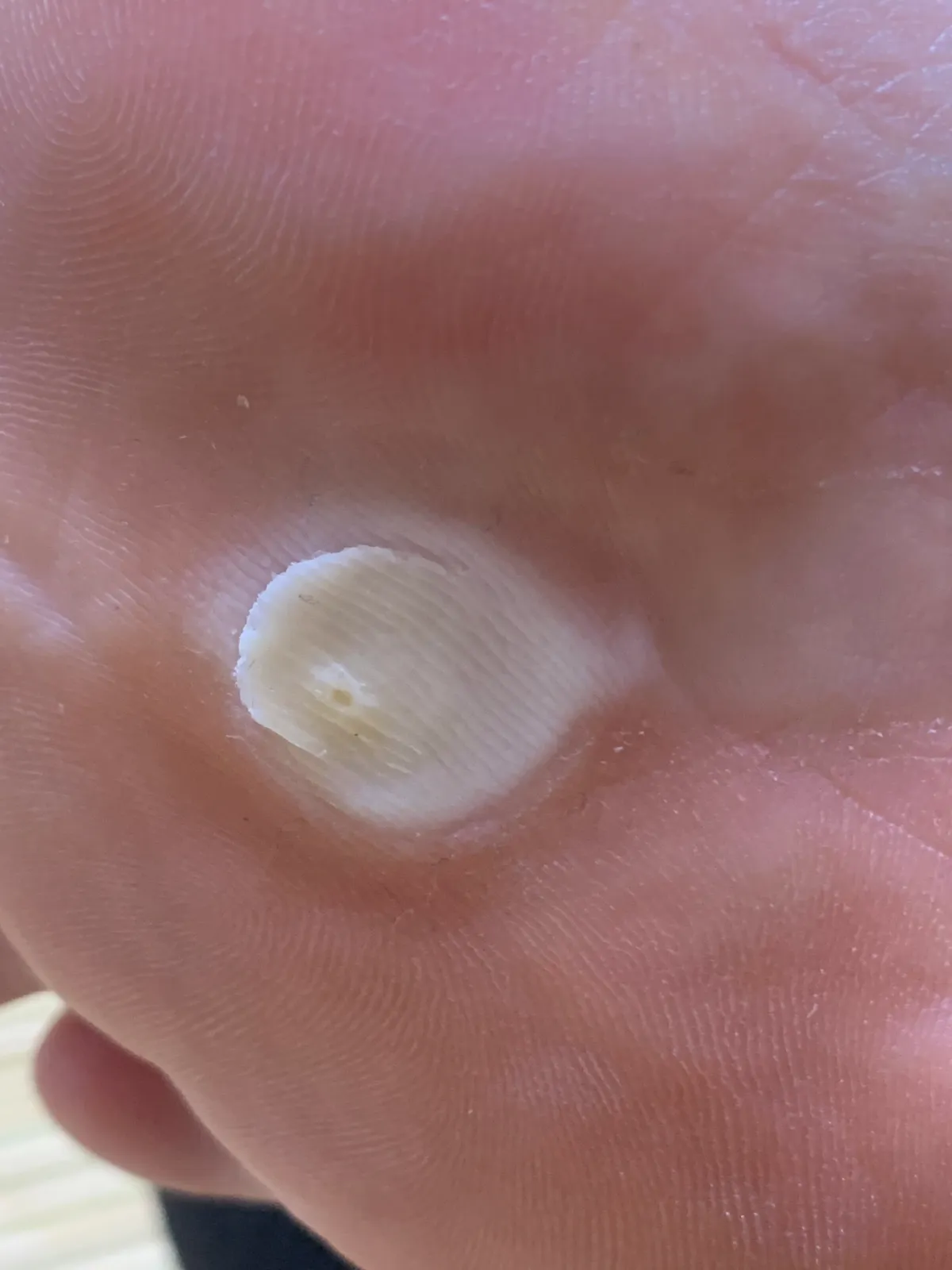 티눈밴드-사용후-발바닥