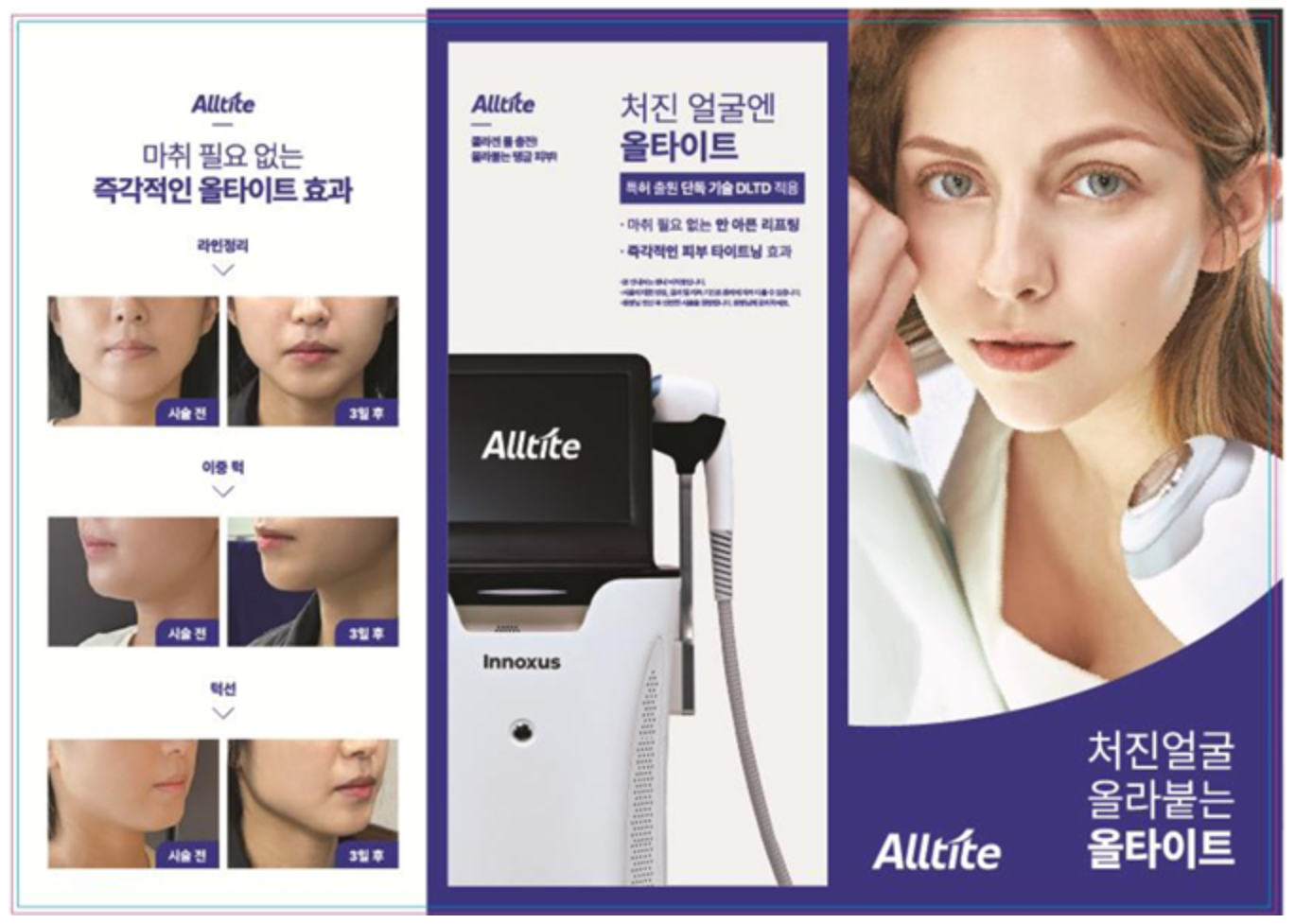 시술 가격과 유지기간