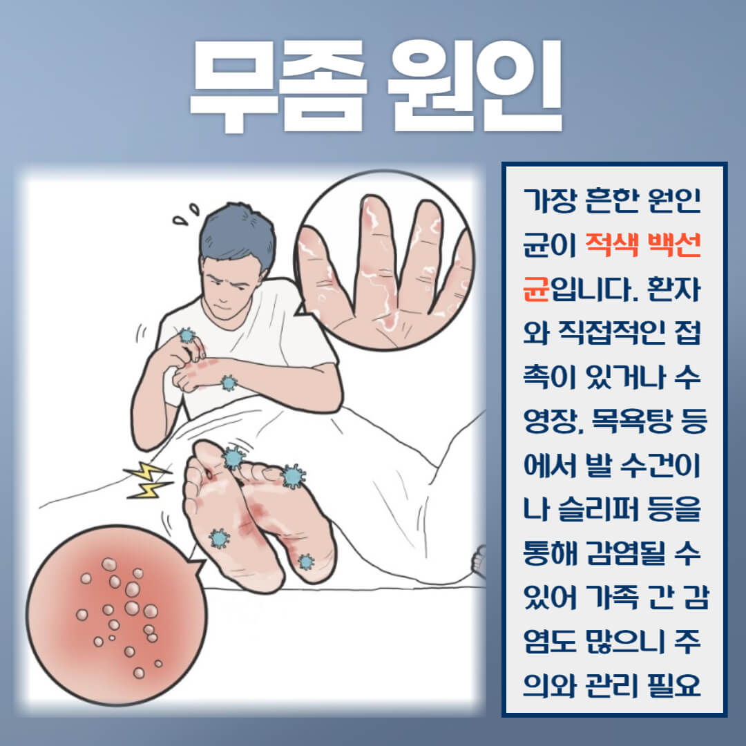무좀 원인