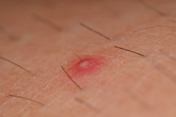 스트레스와 호르몬 불균형