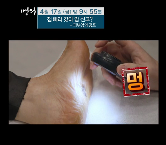 명의 피부암 점 구별법