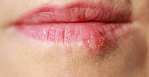 입술 헤르페스 증상