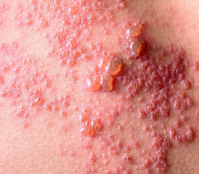 대상포진 회복 기간