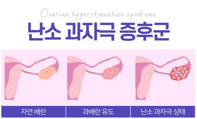 난소 과자극 증후군