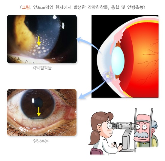 포도막염