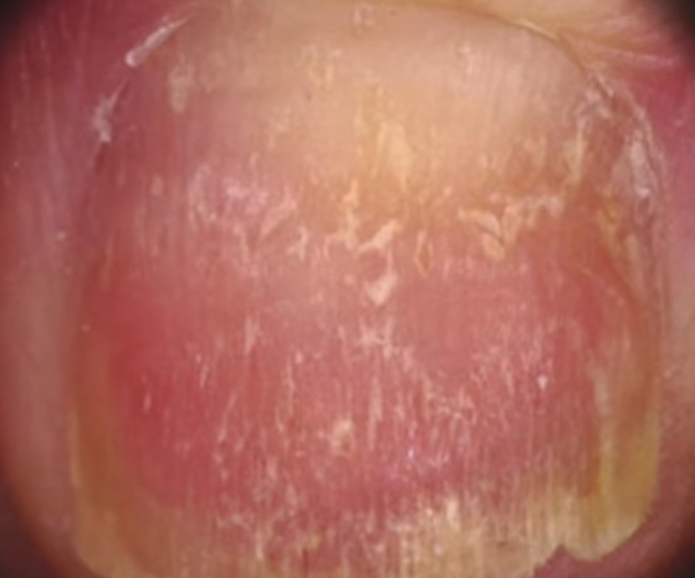 손톱이 잘 부러지는 이유