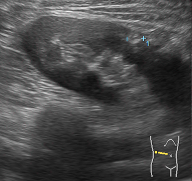 신장 혈관근지방종