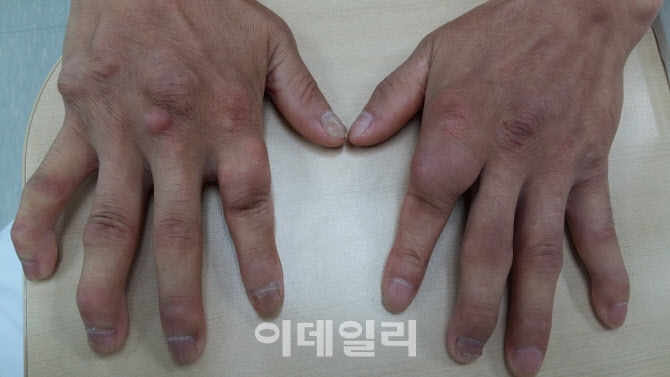 손가락 류마티스 관절염 주요 증상과 체크 리스트
