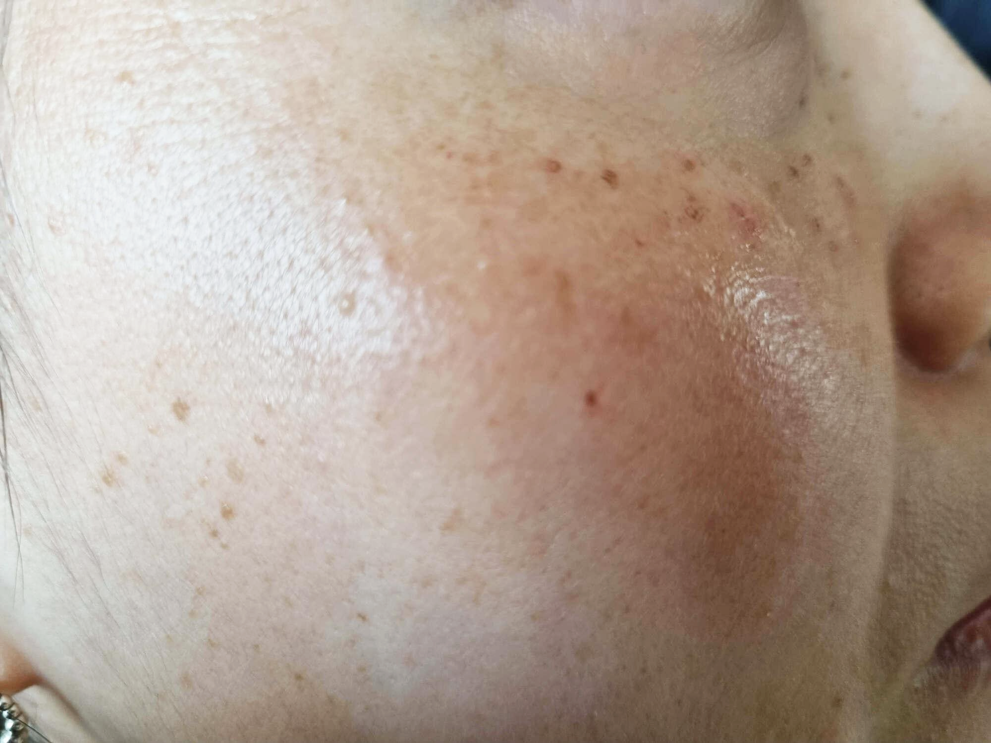 비립종 제거 비용